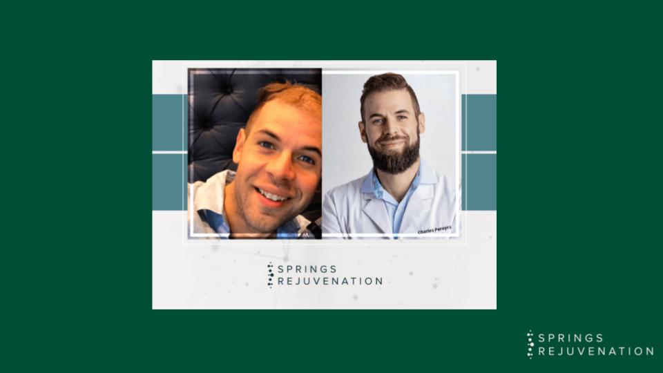 Exosome Hair Restoration Results